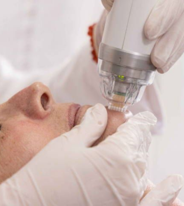 Radiofrecuencia fraccionada