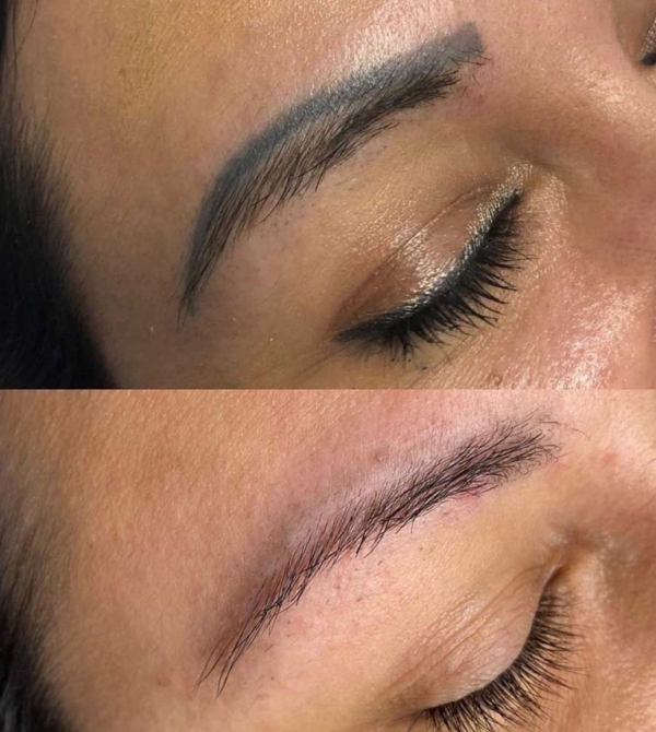 Eliminación de micropigmentación de cejas con láser